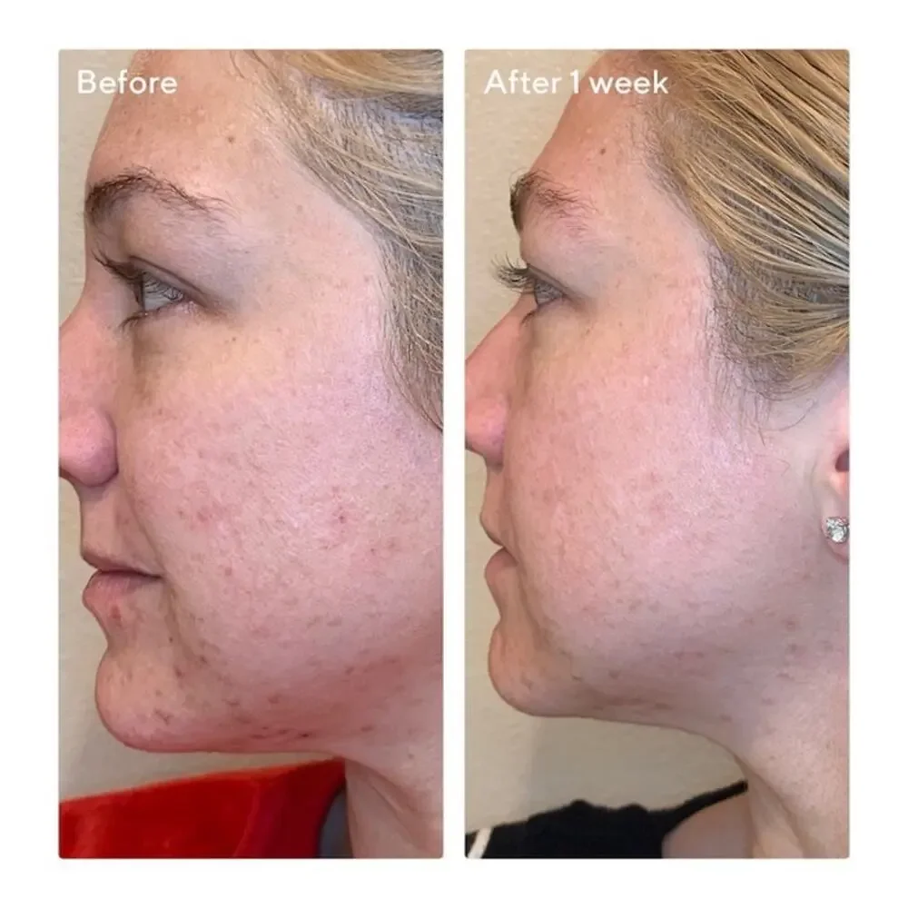 Murad AHA/BHA/Retinoid Daily Clarifying Peel 3.2 fl oz - Picture 3 of 4
